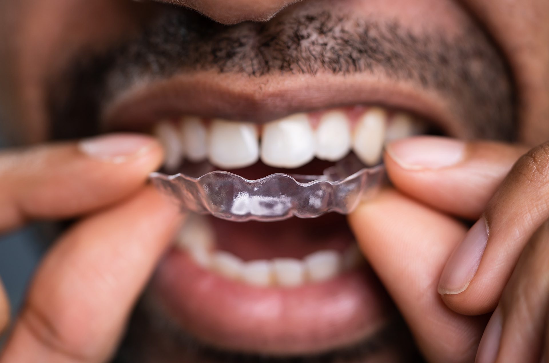 Dr. Pauline Karanja A23 - What To Expect From Your Invisalign® Journey